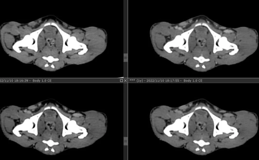 Cynomolgus monkey endometriosis model Cynomolgus monkey endometriosis model